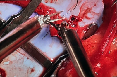 Microsurgical robotic instruments complete anastomosis at fine vessels in vascularized tissue transfer surgery.